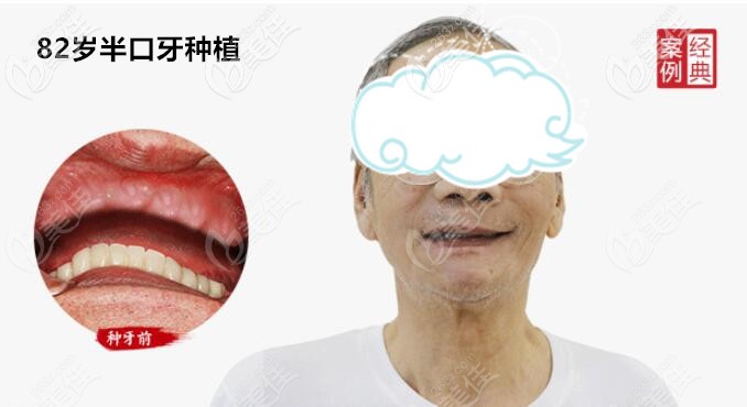 82歲老人，上半口牙缺失，做的allon4半口種植牙