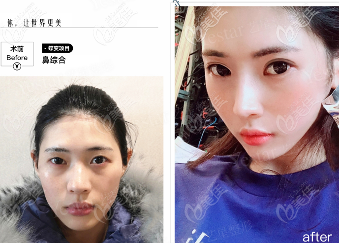 西安藝星做韓士生科一段假體隆鼻<span style= 西安藝星做韓士生科一段假體隆鼻<span style=