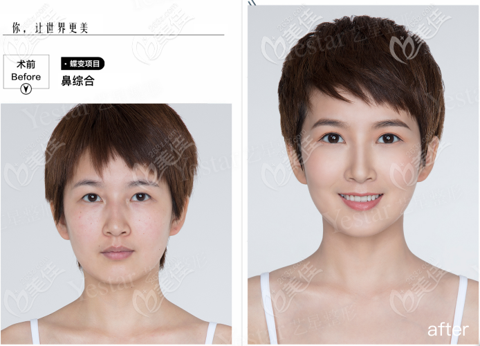 西安藝星做韓士生科一段假體隆鼻<span style= 西安藝星做韓士生科一段假體隆鼻<span style=