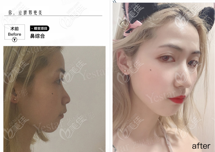 西安藝星做韓士生科一段假體隆鼻<span style= 西安藝星做韓士生科一段假體隆鼻<span style=