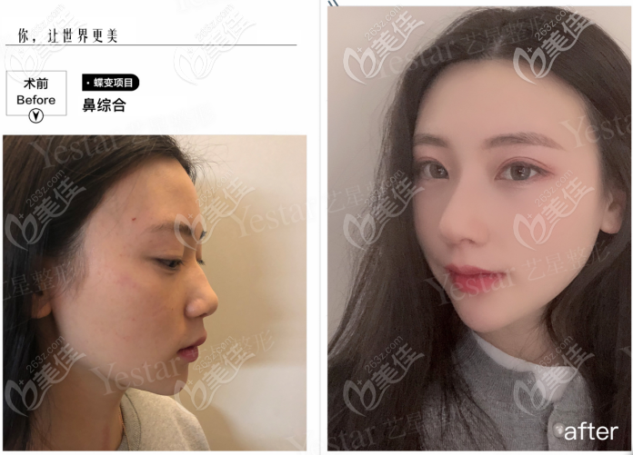 西安藝星做韓士生科一段假體隆鼻的效果怎么樣？用七個(gè)案例證明