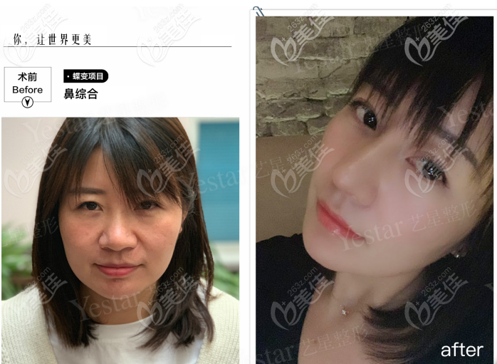 西安藝星做韓士生科一段假體隆鼻<span style= 西安藝星做韓士生科一段假體隆鼻<span style=