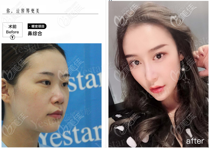 西安藝星做韓士生科一段假體隆鼻<span style= 西安藝星做韓士生科一段假體隆鼻<span style=