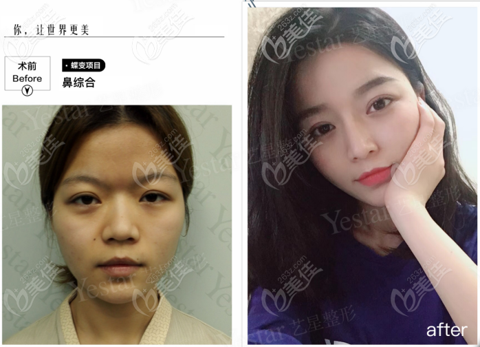 西安藝星做韓士生科一段假體隆鼻<span style= 西安藝星做韓士生科一段假體隆鼻<span style=