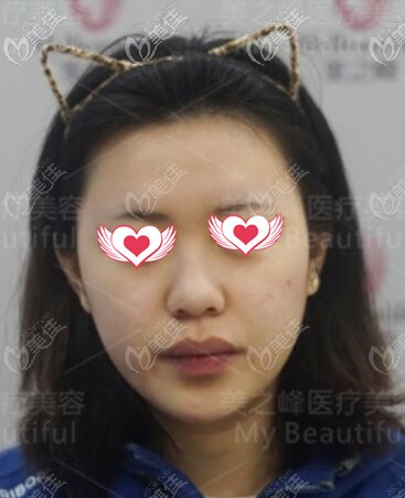 隆鼻術(shù)前照 隆鼻術(shù)前照