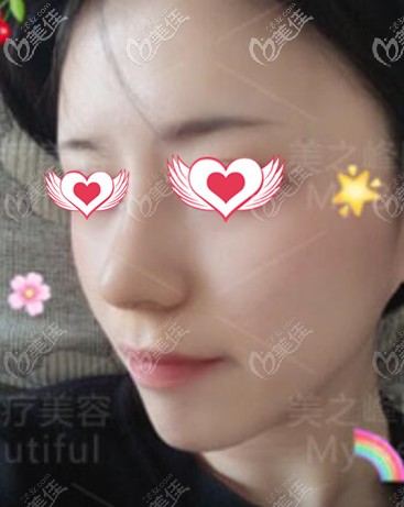 鼻綜合術(shù)后一周照 鼻綜合術(shù)后一周照