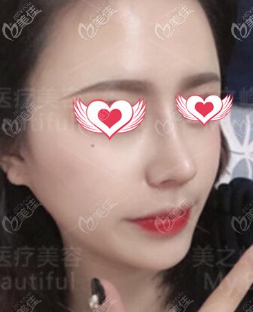 鼻綜合術(shù)后15天效果照 鼻綜合術(shù)后15天效果照