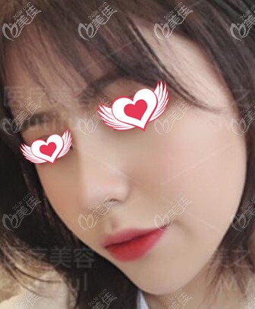 我在長沙美之峰做自體肋軟骨鼻綜合1個月了，效果還不錯哦！