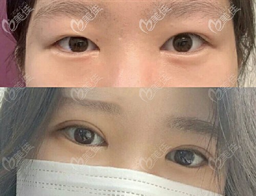 高振欣雙眼皮案例 高振欣雙眼皮案例