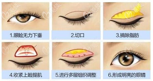 全切雙眼皮加提肌手術(shù)全過程 全切雙眼皮加提肌手術(shù)全過程