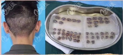 確定手術(shù)，提取后枕部毛囊