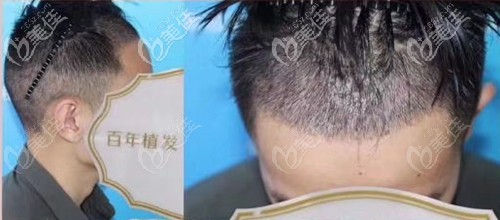 我的發(fā)際線種植恢復(fù)過程圖片，20天植發(fā)區(qū)頭發(fā)長得又粗又硬!