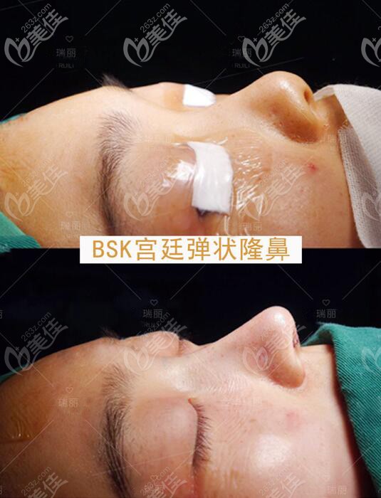 吳昌炎肋骨鼻對比效果圖