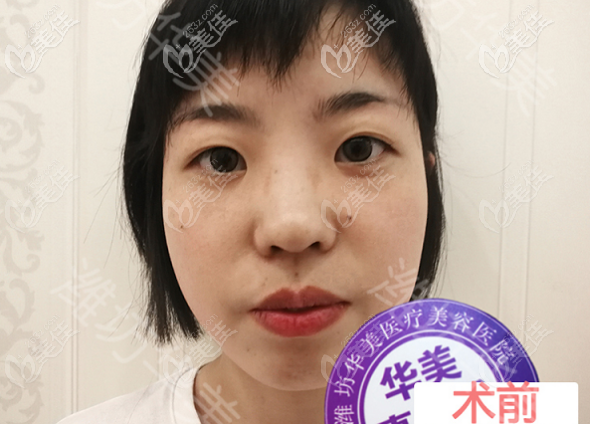 濰坊華美做埋線雙眼皮術(shù)前照片 濰坊華美做埋線雙眼皮術(shù)前照片