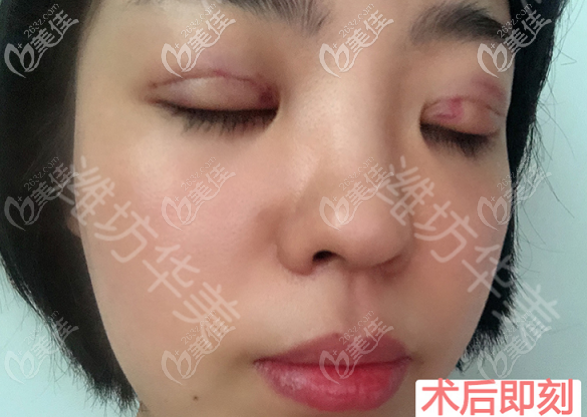 濰坊華美做埋線雙眼皮術(shù)后即刻照片 濰坊華美做埋線雙眼皮術(shù)后即刻照片