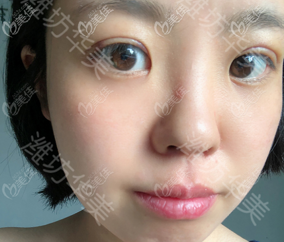 濰坊華美做埋線雙眼皮術(shù)后半個(gè)月的樣子 濰坊華美做埋線雙眼皮術(shù)后半個(gè)月的樣子