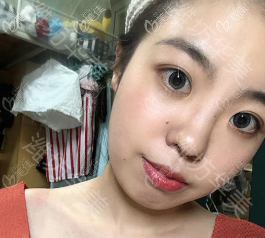 濰坊華美做埋線雙眼皮術(shù)后一個(gè)月的樣子 濰坊華美做埋線雙眼皮術(shù)后一個(gè)月的樣子