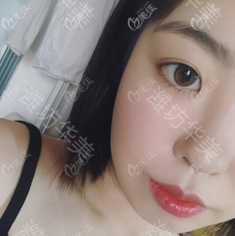 濰坊華美做埋線雙眼皮術(shù)后三個(gè)月的樣子 濰坊華美做埋線雙眼皮術(shù)后三個(gè)月的樣子