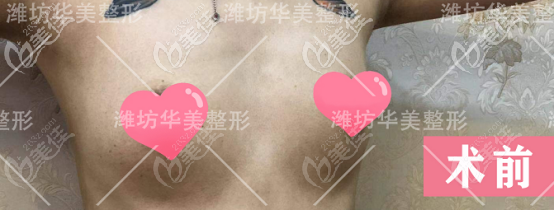 隆胸術前照片 隆胸術前照片