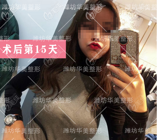 濰坊華美做隆胸的術后第15天狀態(tài) 濰坊華美做隆胸的術后第15天狀態(tài)