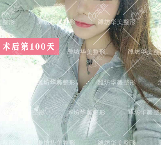 濰坊華美做曼托假體隆胸蠻好的，我用的是225CC大小的假體