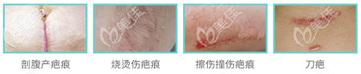 各類(lèi)疤痕 各類(lèi)疤痕