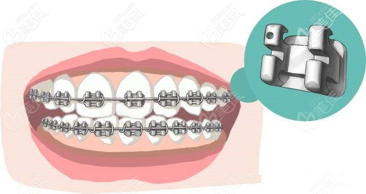 自鎖牙套的鎖扣