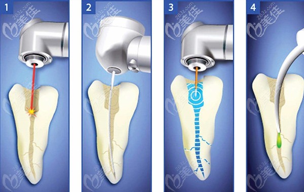 根管治療步驟及過程圖 根管治療步驟及過程圖