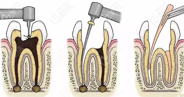 南京做一次性根管治療的費用 南京做一次性根管治療的費用
