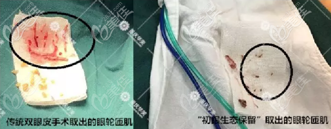 初眼生態(tài)保留術(shù)和傳統(tǒng)雙眼皮術(shù)的區(qū)別 初眼生態(tài)保留術(shù)和傳統(tǒng)雙眼皮術(shù)的區(qū)別