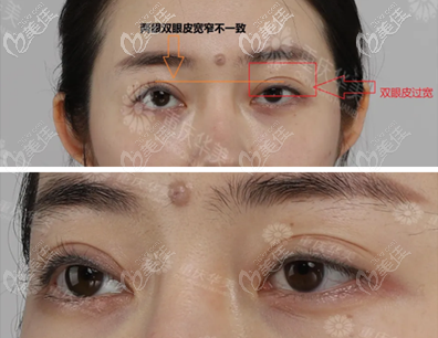 術(shù)前眼睛寬窄不一 術(shù)前眼睛寬窄不一