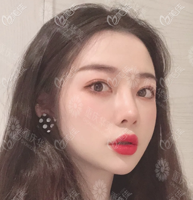 重慶華美雙眼皮寬改窄案例圖片 重慶華美雙眼皮寬改窄案例圖片