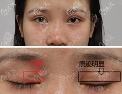 術(shù)前割的過深 術(shù)前割的過深