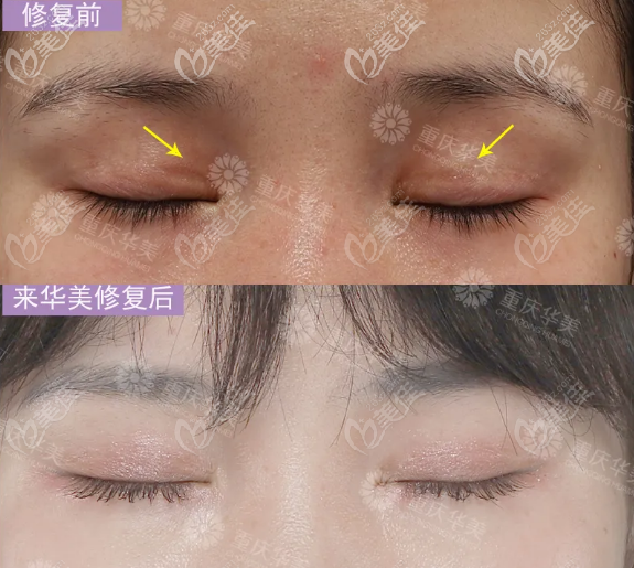 閉眼無痕 閉眼無痕