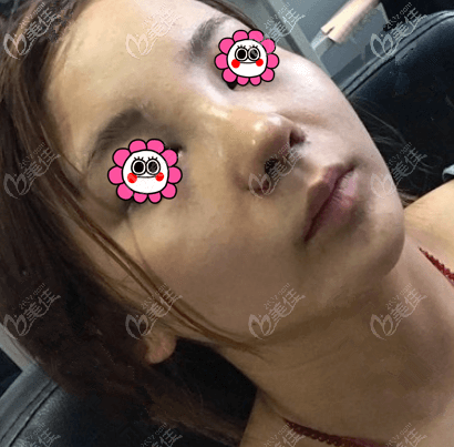 做耳軟骨復(fù)合隆鼻有2天了