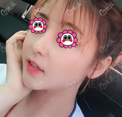 宮國(guó)華做鼻子怎么樣？從我做耳軟骨復(fù)合隆鼻效果了解