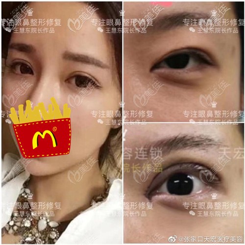 張家口天宏眼綜合對比案例