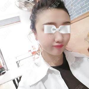 魏瑞鎖醫(yī)生為我做脂肪豐太陽(yáng)穴術(shù)后一周臉微腫