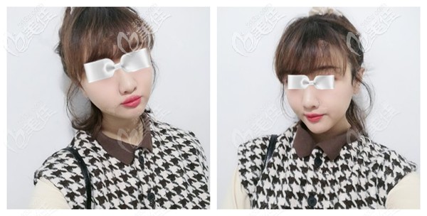 魏瑞鎖醫(yī)生為我注射脂肪豐太陽(yáng)穴術(shù)后完全消腫