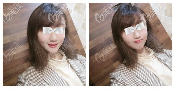 在石家莊創(chuàng)美做脂肪填充太陽(yáng)穴術(shù)后恢復(fù)自然