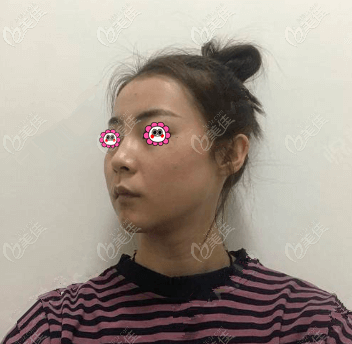 做V美減齡V3定格青春術(shù)前 做V美減齡V3定格青春術(shù)前