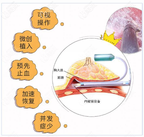 廣州荔灣區(qū)<!--<i data=20240709-sp></i>-->常輝彥醫(yī)生內(nèi)窺鏡隆胸技術(shù)優(yōu)勢(shì)