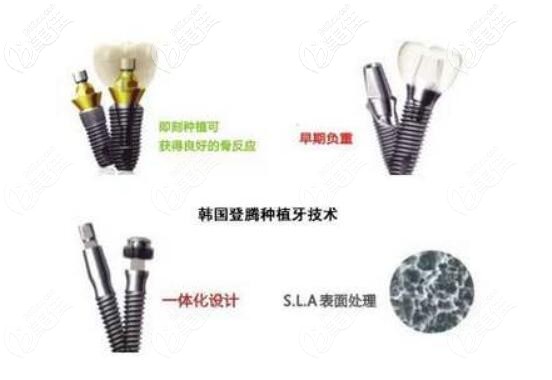韓國(guó)登騰Dentium種植牙特點(diǎn)