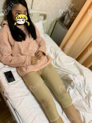 水動(dòng)力吸脂瘦大腿術(shù)后3天恢復(fù)照 水動(dòng)力吸脂瘦大腿術(shù)后3天恢復(fù)照