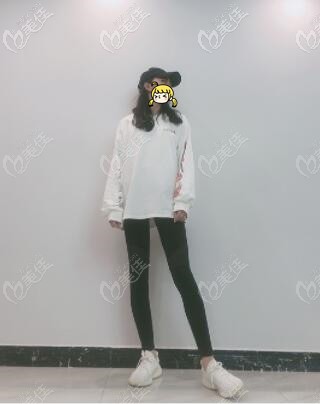 水動(dòng)力吸脂瘦大腿術(shù)后半個(gè)月恢復(fù)照 水動(dòng)力吸脂瘦大腿術(shù)后半個(gè)月恢復(fù)照