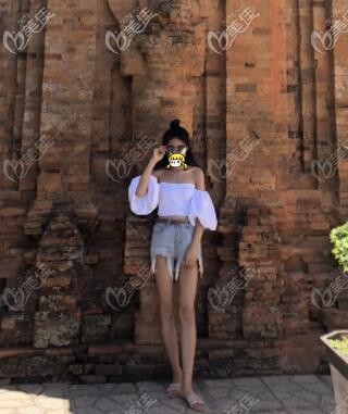 我在大連星妍醫(yī)療美容做水動(dòng)力大腿吸脂55天后瘦了近5cm，恢復(fù)效果圖公開(kāi)！