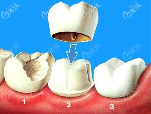 烤瓷牙牙冠 烤瓷牙牙冠