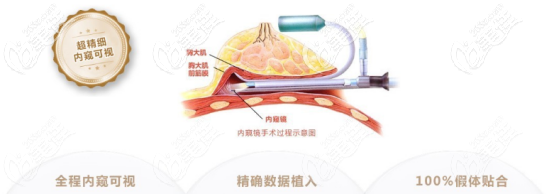 陳成醫(yī)生做內(nèi)窺鏡隆胸的優(yōu)勢