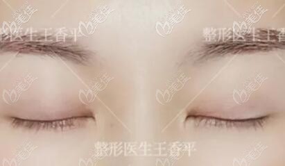 劉志剛重瞼術(shù)術(shù)后恢復(fù)好閉眼效果照