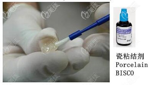 冰瓷牙用的粘結(jié)劑